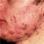Cystic acne on the jaw