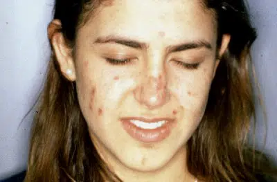 Acne Young Girl