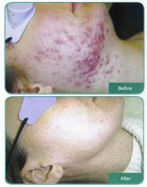 acne laser skin treatment