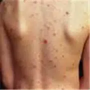 back acne