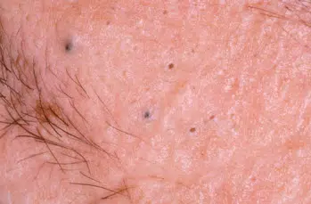 blackheads