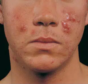 cystic acne