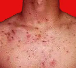 chest acne