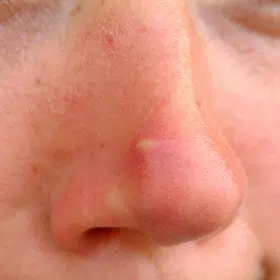 nose whitehead
